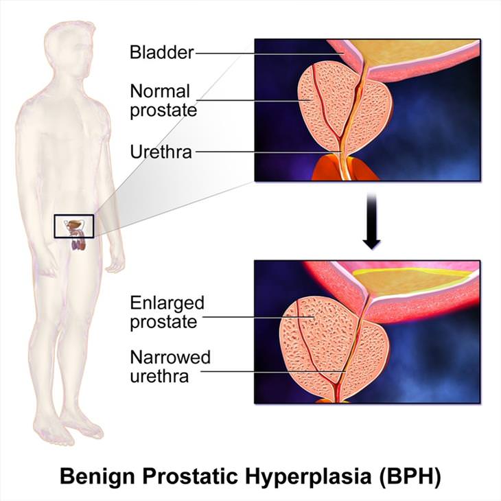 nocturia Enlarged Prostate