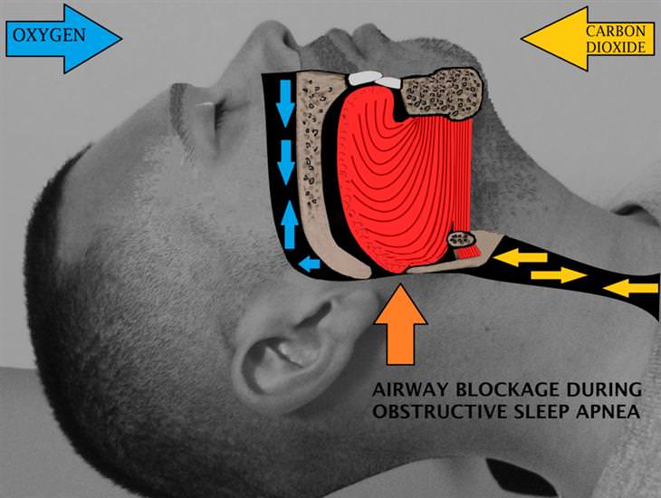 nocturia Obstructive Sleep Apnea