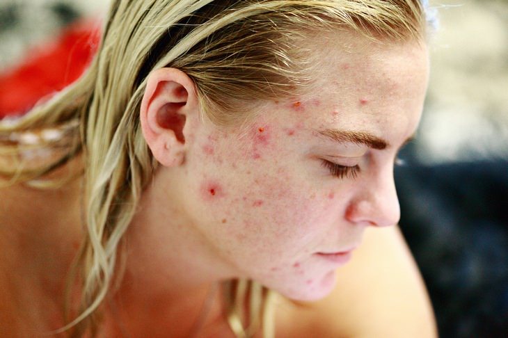 Health myths: acne