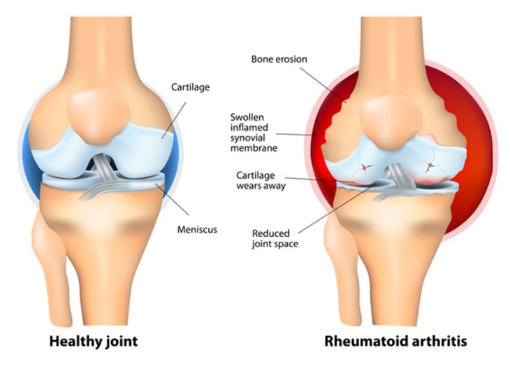 baking soda arthritis diagram