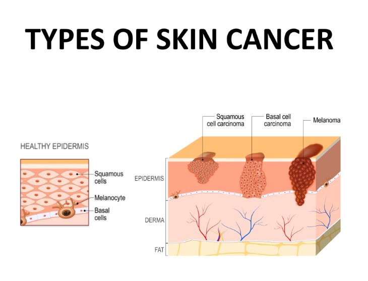 sun exposure myths skin cancer