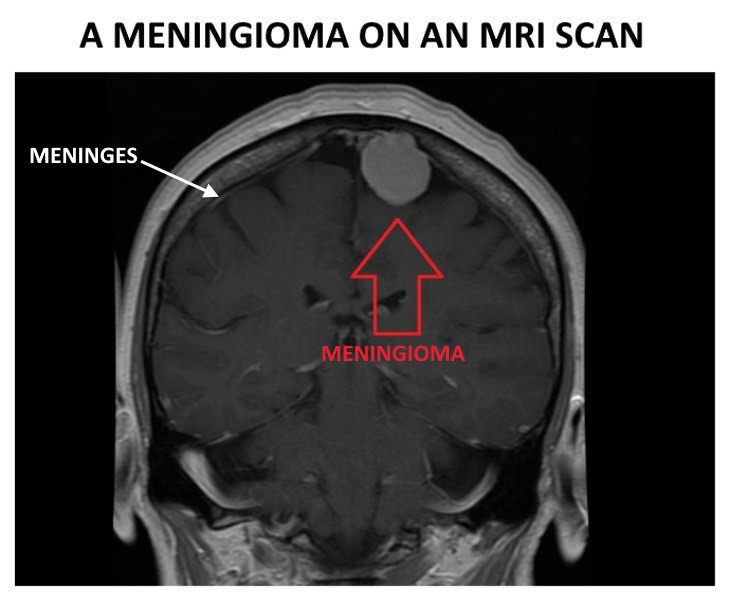 meningioma MRI