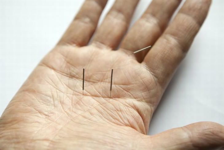 Ankylosing spondylitis Acupuncture