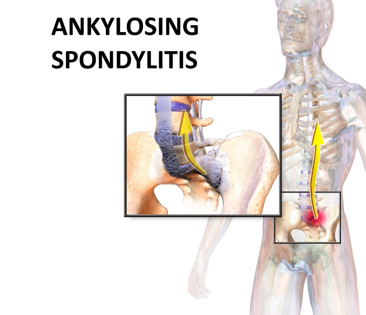 Ankylosing spondylitis  Signs and Symptoms Of Ankylosing Spondylitis?