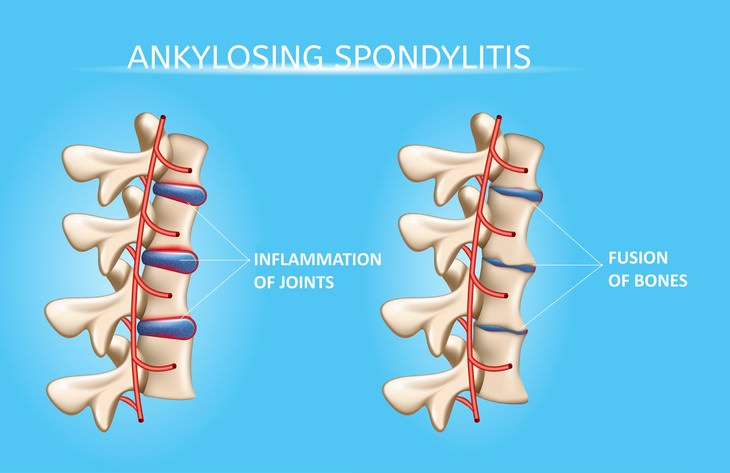 Ankylosing spondylitis symptoms