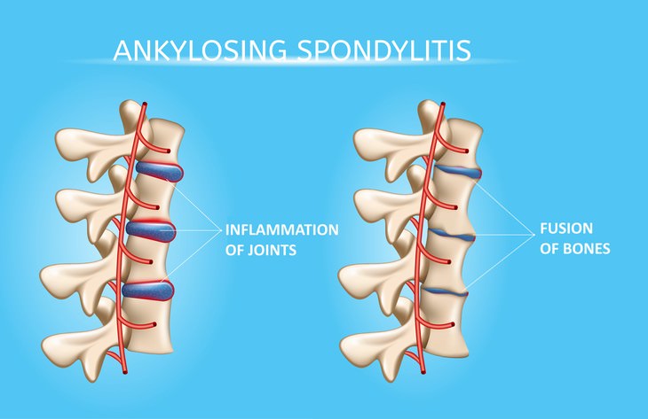 Home Treatments of Ankylosing Spondylitis