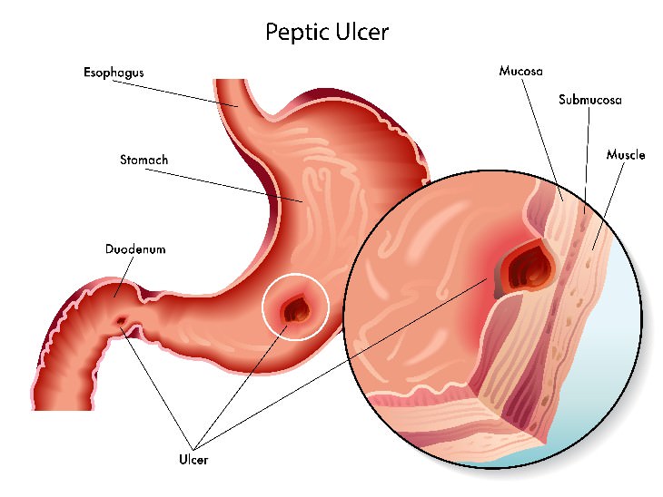 chili peppers Weight loss peptic ulcers