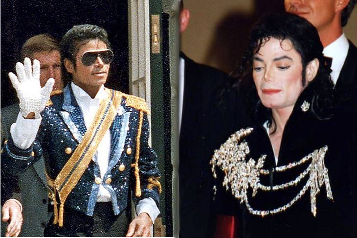 Vitiligo: Michael Jackson