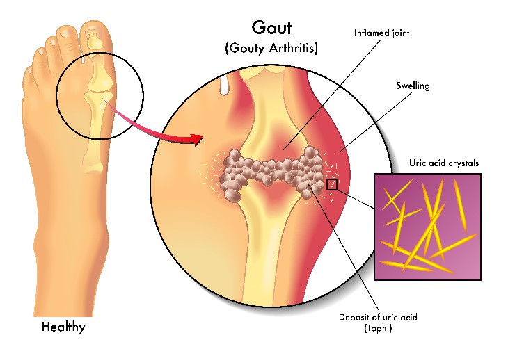 Vitamin C health benefits Prevents Gout Attacks