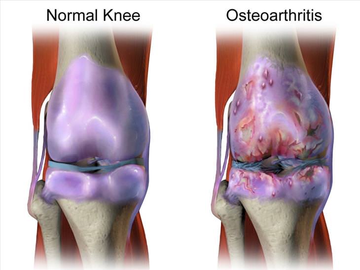 Tuina massage guide osteoarthritis