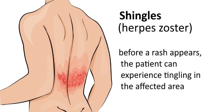tingling in the back causes Shingles