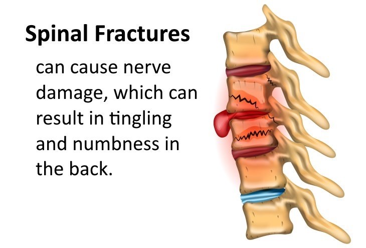 tingling in the back causes  Spinal fracture