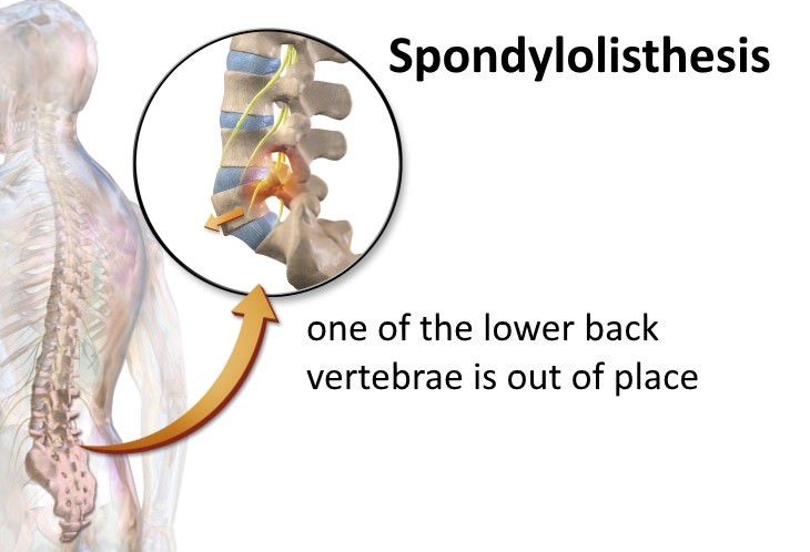 tingling in the back causes Spondylolisthesis 
