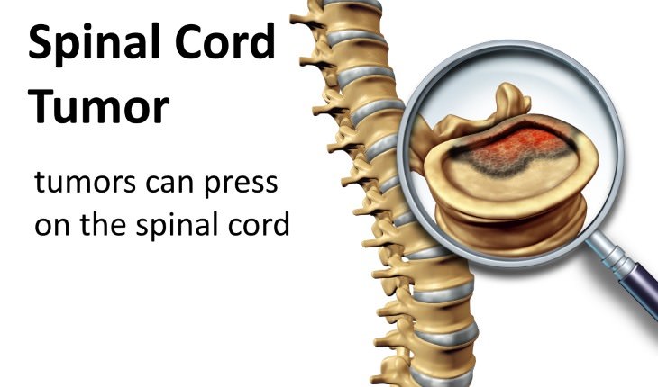 tingling in the back causes Spinal cord tumor