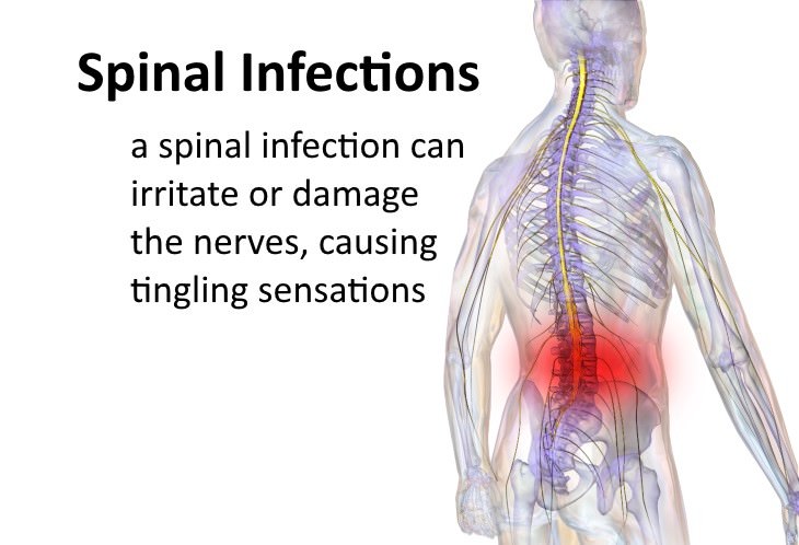 tingling in the back causes Spinal infections