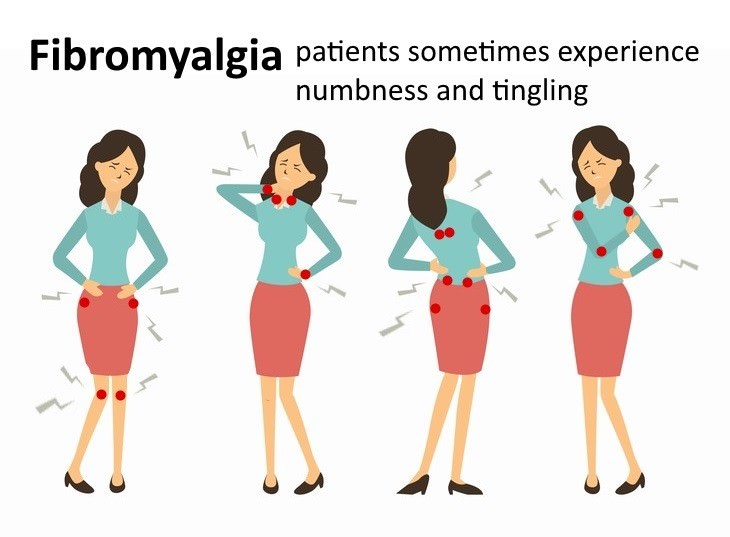 tingling in the back causes  Fibromyalgia