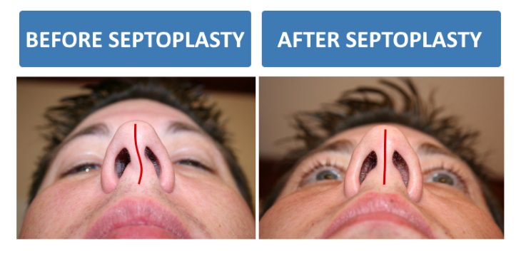 deviated septum guide septoplasty