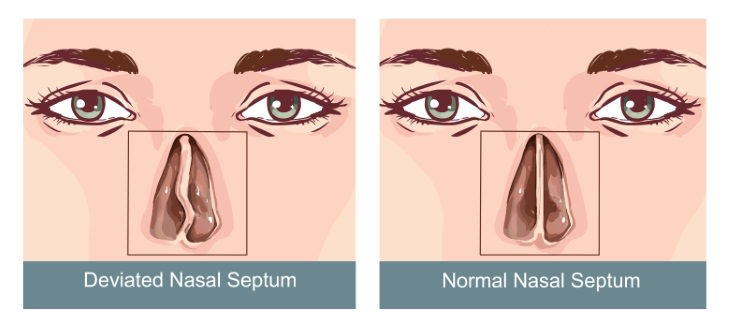 deviated septum guide what it looks like