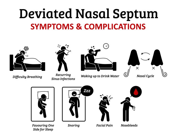 deviated septum guide symptoms and complications