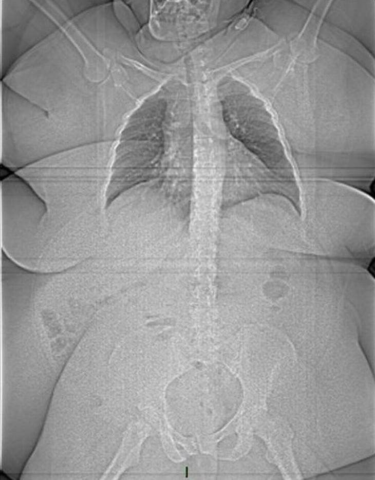 X-Ray Images overweight person