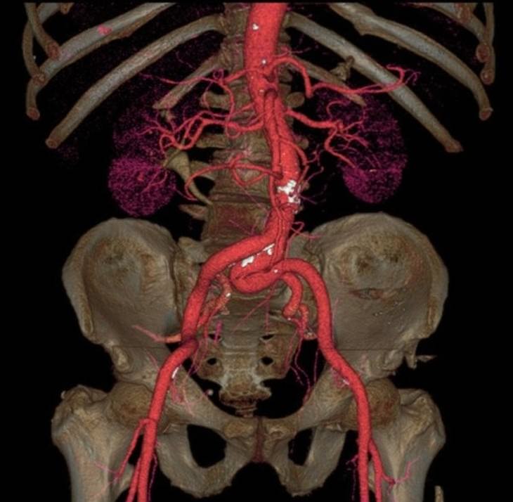 X-Ray Images aorta
