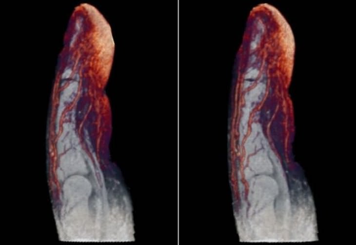 X-Ray Images blood vessels in the fingers