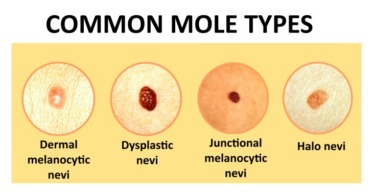 skin mole removal common mole types