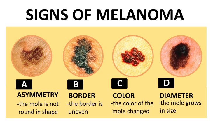 skin mole removal symptoms of melanoma