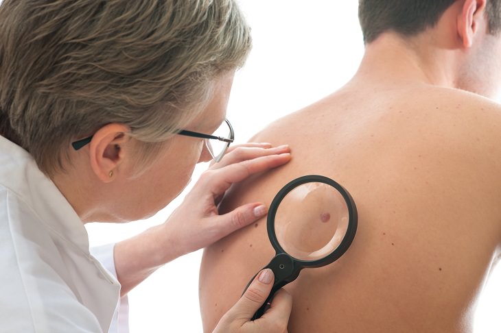 skin mole removal doctor checks mole on the back