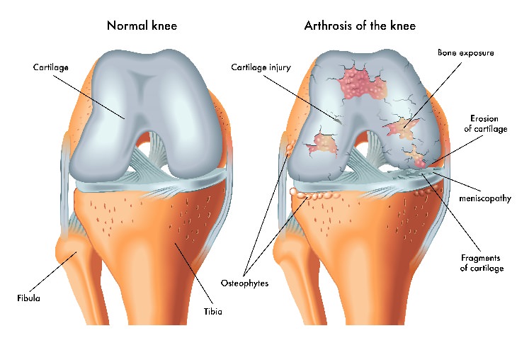 Supplements: Glucosamine Chondroitin cartilage