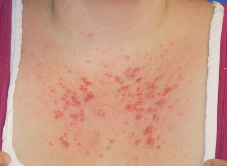 Sun allergy PLE: hives