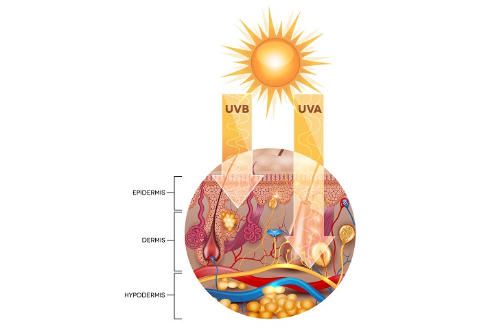 Sun allergy PLE: UV radiation