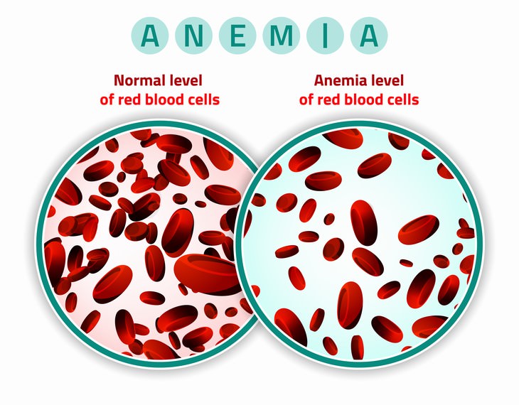 Causes of Muscle Weakness Anemia