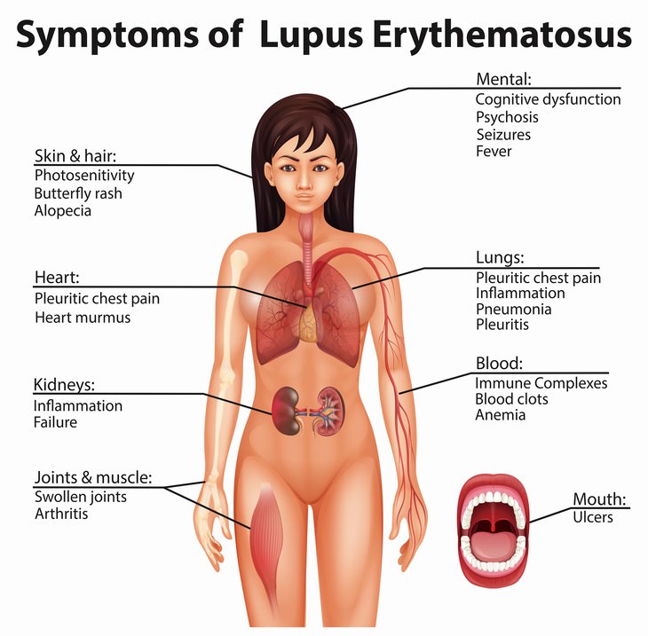 Causes of Muscle Weakness Lupus