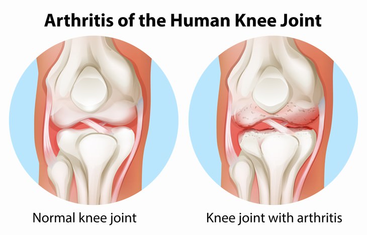 Causes of Muscle Weakness Rheumatoid arthritis