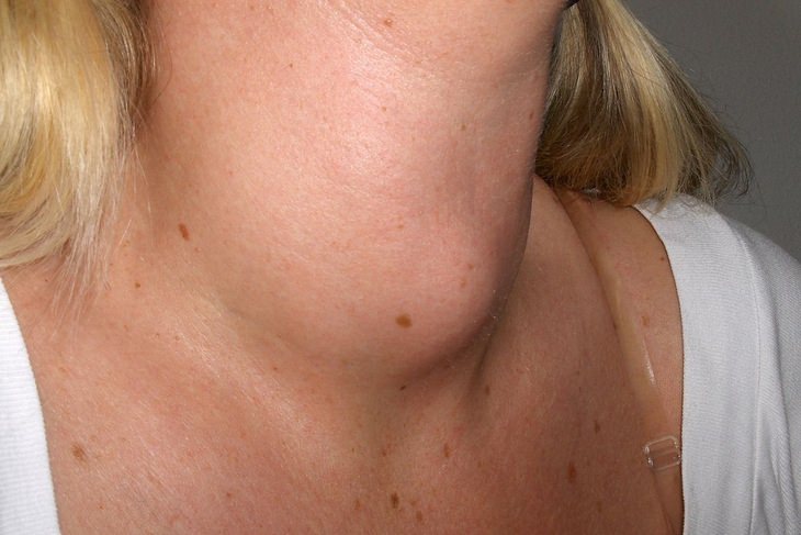 Thyroid disorders: goiter