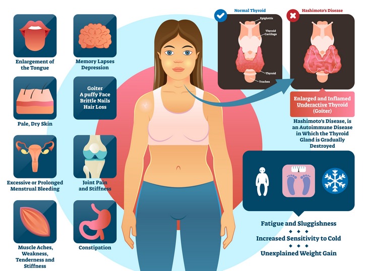 Thyroid disorders: Hashimoto's disease thyroiditis