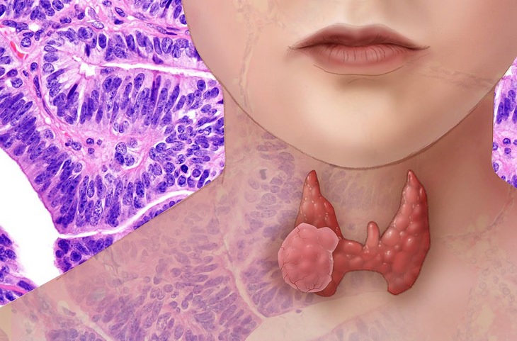 Thyroid disorders: thyroid cancer
