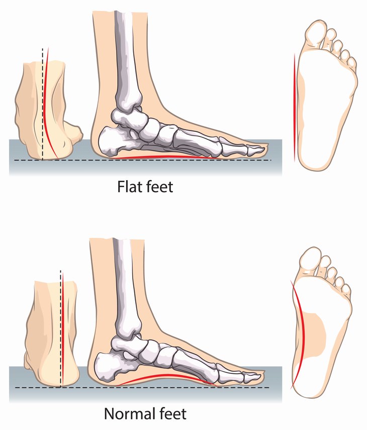 night leg cramps flat foot