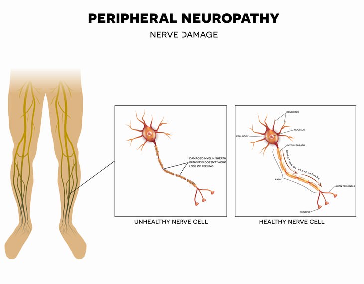 night leg cramps peripheral neuropathy