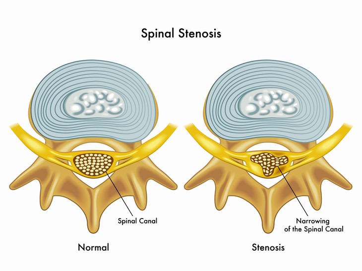 night leg cramps spinal stenosis