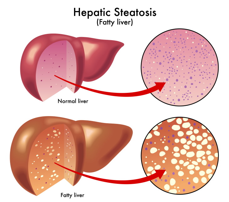 NAFLD and Gut Microbiome healthy vs fatty liver