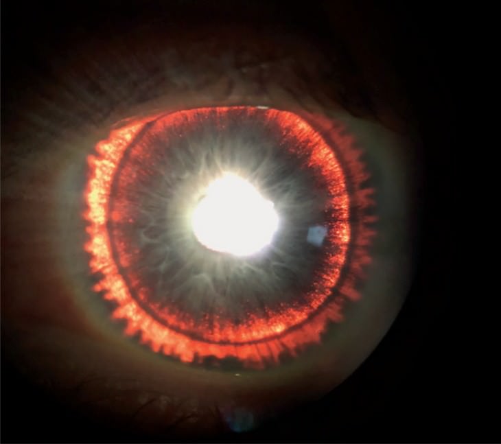 Bizarre Medical Cases of 2019 glowing iris