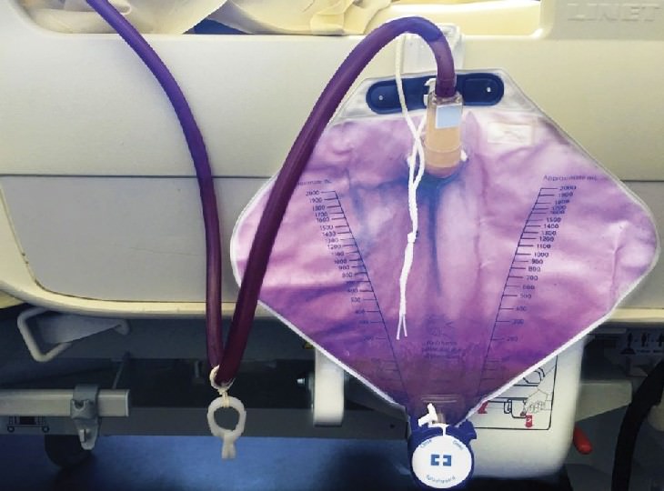 Bizarre Medical Cases of 2019 purple urine