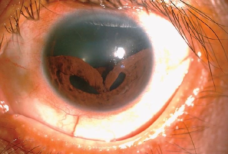 Bizarre Medical Cases of 2019 A Collapsed Iris