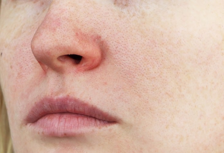 9 Conditions You Think Are Contagious But Aren't, rosacea