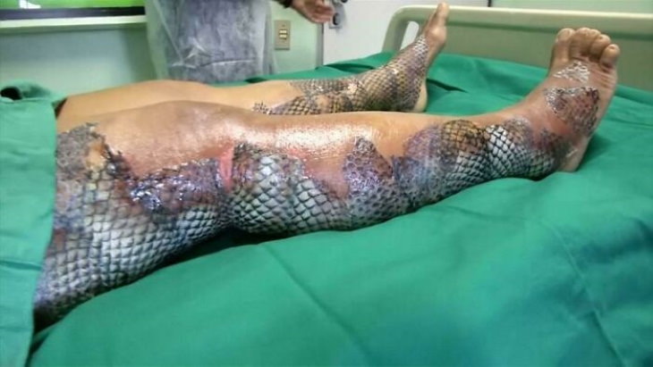 Fotos Asombrosas Con Una Historia Detrás De Ellas Cierta piel de pescado se puede injertar en quemaduras y heridas diabéticas