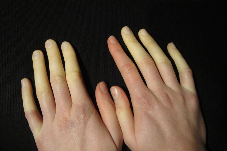 Cold Feet Causes and Remedies Raynaud Syndrome