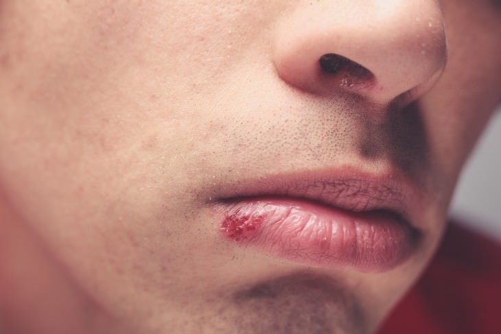 signs stress is harming your health man with cold sore