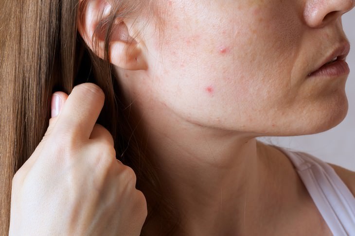 signs stress is harming your health woman with acne